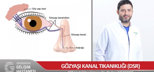 Gözyaşı Kanal Tıkanıklığına Endoskopik Tedavi